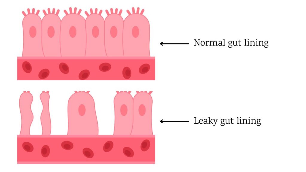 A side-by-side illustration comparing a healthy gut lining with tightly packed cells to a leaky gut lining with gaps, showing how undigested food particles and toxins can pass into the bloodstream, triggering inflammation, which can affect the immune system and fertility.